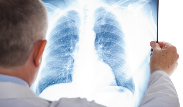 Cancer du poumon : 3 questions au Pr Cadranel, chef du service de pneumologie à l’hôpital Tenon