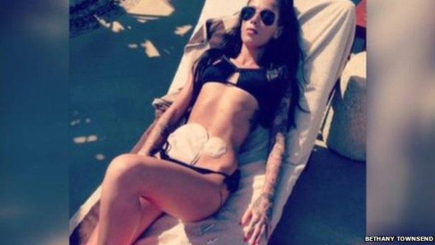 Maladie de Crohn : elle pose en bikini et suscite l’émotion de tous
