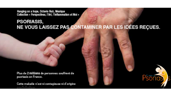 Journée mondiale du psoriasis pour changer le regard des autres