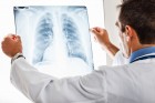 Ralentir l’évolution de la fibrose pulmonaire idiopathique, c’est possible !