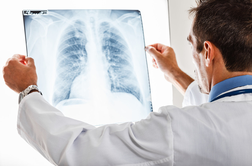 Ralentir l'évolution de la fibrose pulmonaire idiopathique, c'est ...