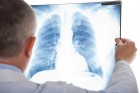 Tout savoir sur la fibrose pulmonaire idiopathique