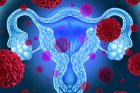 Cancer de l’endomètre et de l’utérus, comment les dépister ?