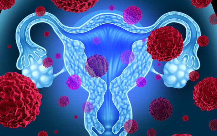 Cancer de l’endomètre et de l’utérus, comment les dépister ?