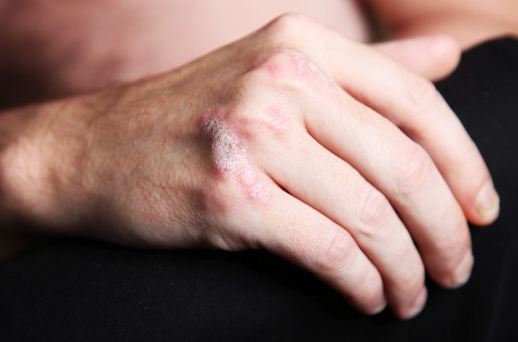 Le psoriasis a failli ruiner sa vie amoureuse