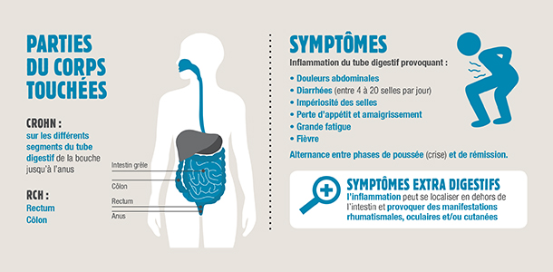 Une infographie pour sensibiliser aux MICI