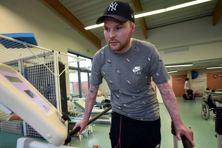 Greffe de peau : sauvé grâce à son frère jumeau !