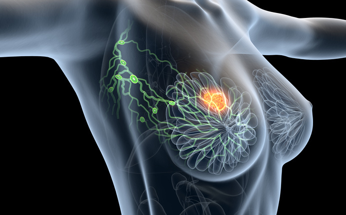 Cancer du sein : les progrès de la radiothérapie - Voix des patients