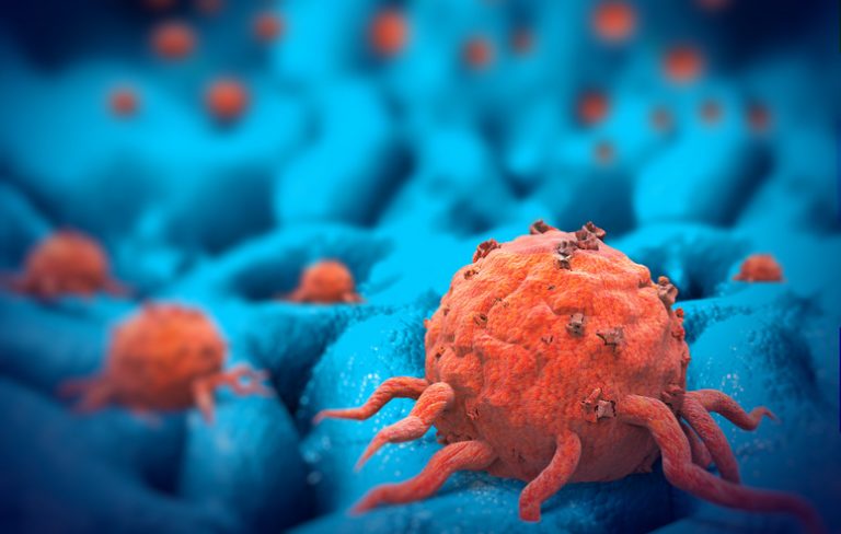 Traitement du cancer : et si on affamait les tumeurs ?